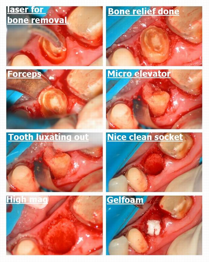 Resize of Bridge and laser for extraction final pg 2.jpg